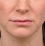 Close-up of lips before lip lift, showing subtle upper lip definition.