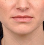 Close-up of lips post-lip lift procedure, revealing enhanced upper lip volume and definition.