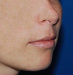 Profile photograph of the face before lip lift surgery, with a relaxed facial expression.
