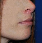 Profile view of face post-lip lift