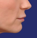 Photo en gros plan des lèvres avec un léger sourire, mettant en valeur la forme naturelle de la bouche avant le lip lift.