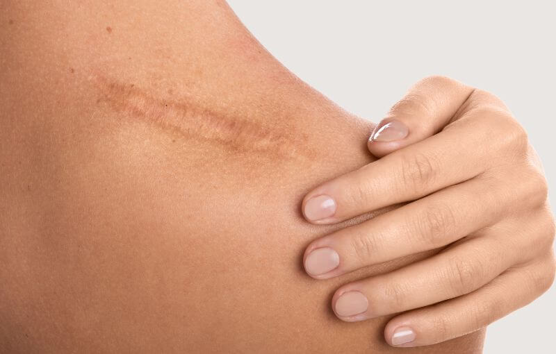 Littekens verwijderen met laser