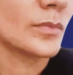 Vue en trois quarts du visage avant de lip lift, montrant les lèvres au repos.
