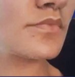 Vue en trois quarts du visage après de lip lift, montrant une harmonie faciale améliorée et des lèvres plus définies.