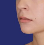 photo of lips before lip lift, showing minimal upper lip definition