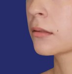 Gros plan des lèvres avant de lip lift