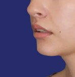 lips after lip lift, revealing increased volume and improved definition of the upper lip.