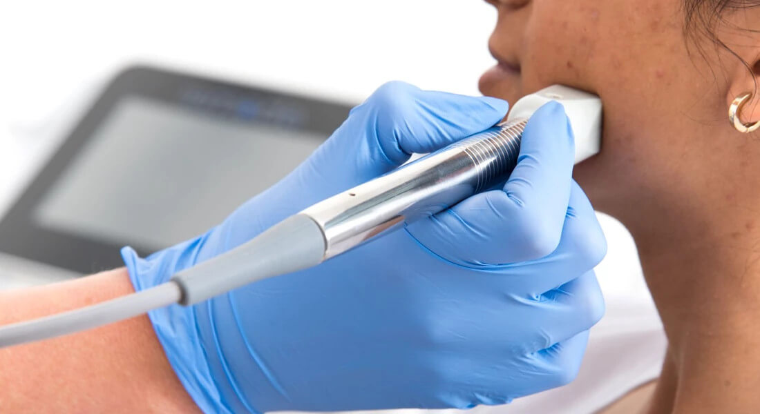 Hoe kan je STRIAE en LITTEKENS VERWIJDEREN? Snel resultaat met een striae laser