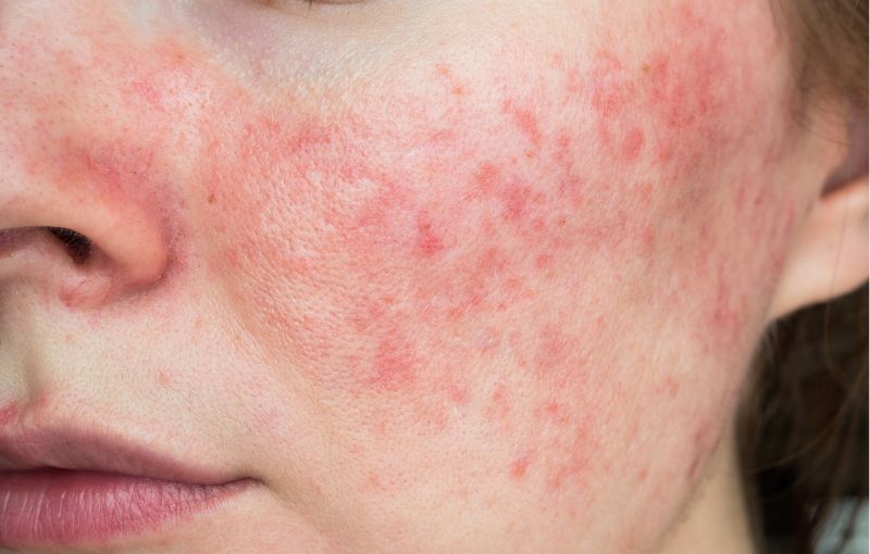 Couperose behandelen
