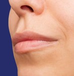 Photographie de profil du visage avant Augmentation des levres avec fillers