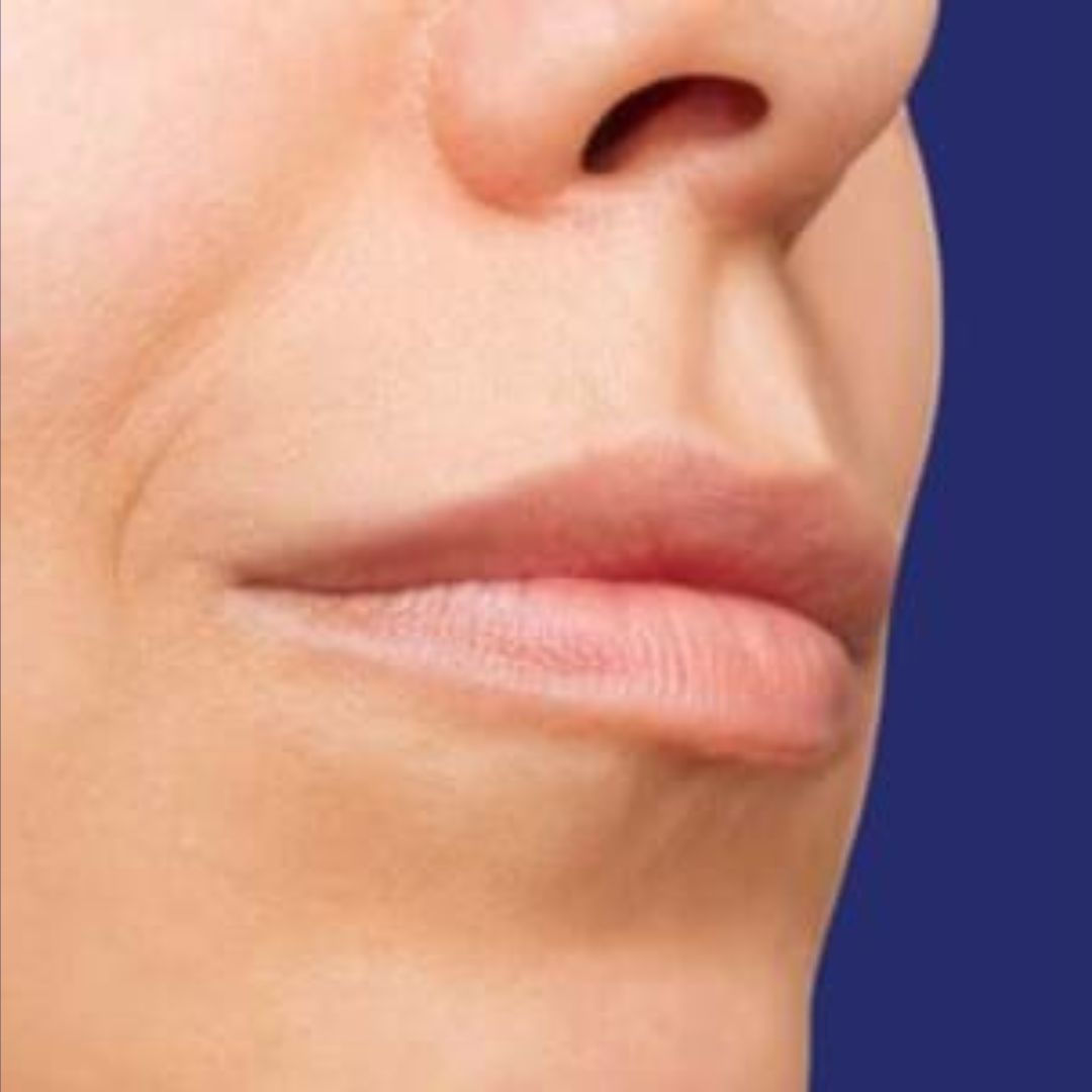 Profielfoto van het gezicht vóór de Lipvergroting met fillers