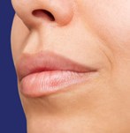 Vue de profil du visage après le Augmentation des levres avec fillers
