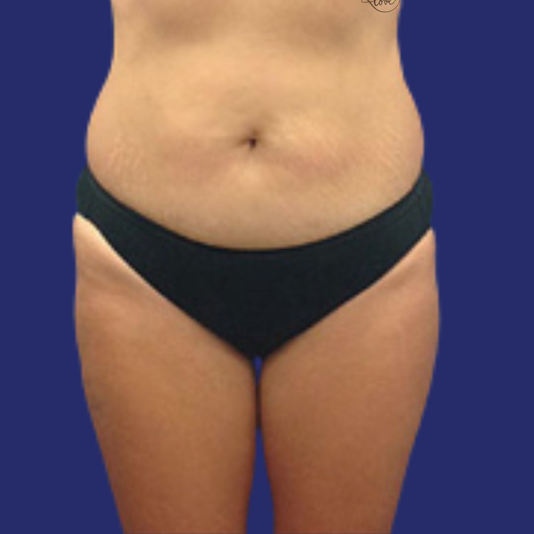 Photo results liposuction saddlebags