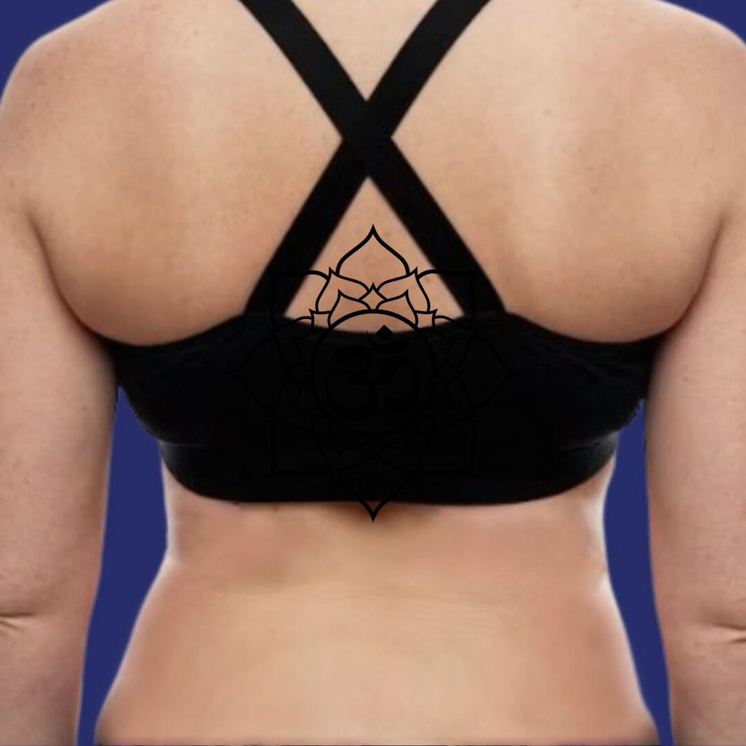 Foto nach der Fettabsaugung am Rücke