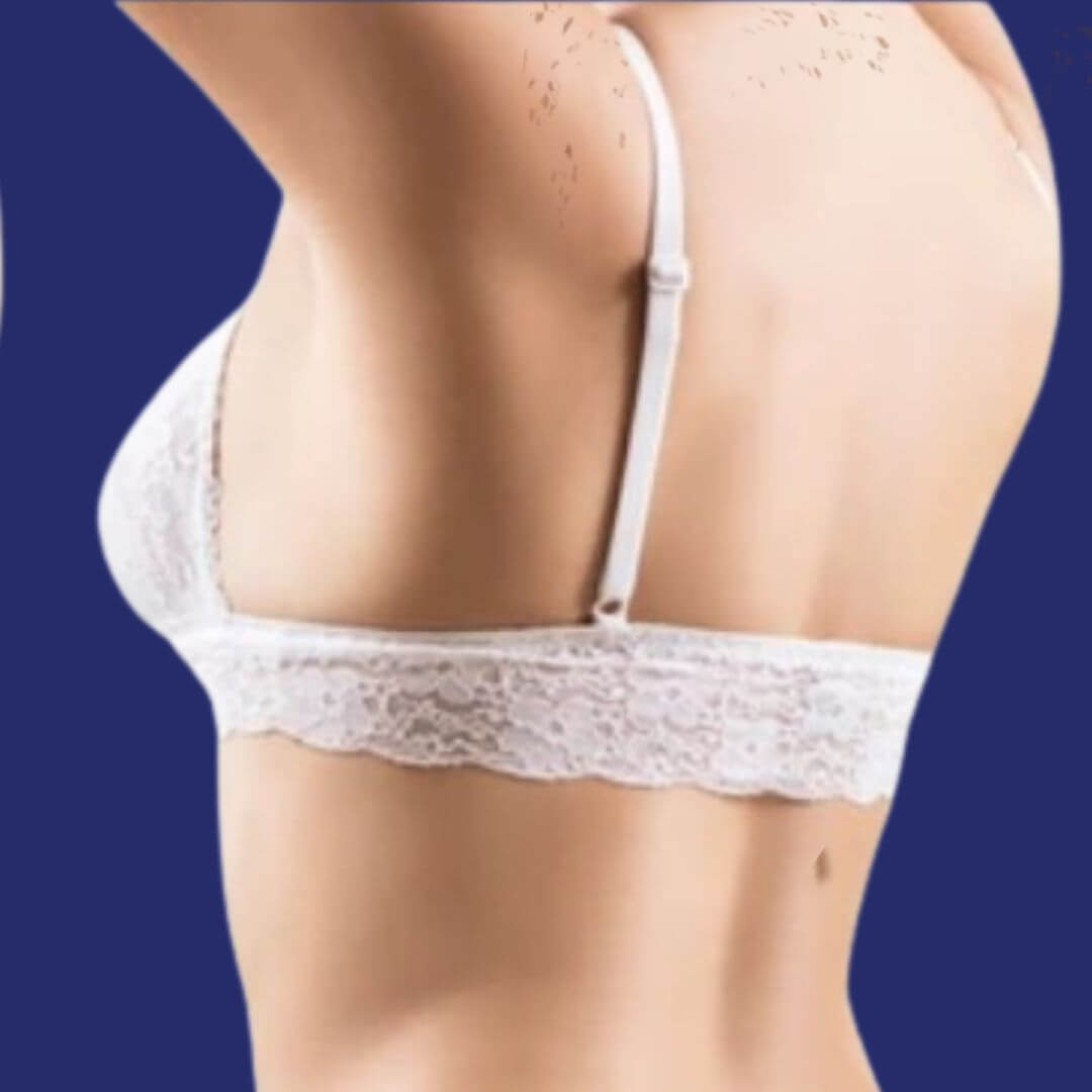  Foto des Ergebnisses der Fettabsaugung am Rücken