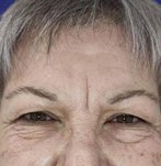 Before eyelid surgery
