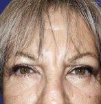 After eyelid surgery