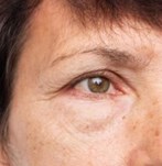 Comparison before and after eyelid surgery