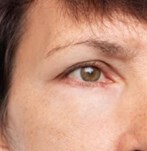 Eyelid surgery results