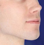 Masculinisation faciale avant et après avec des fillers dans le menton et la mâchoire