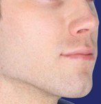 Résultats avant et après des injections de fillers faciaux à l'acide hyaluronique en Belgique