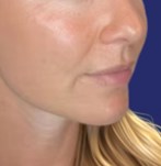 Images avant et après du traitement facial avec des fillers dans le menton, résultats naturels