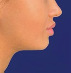Comparaison des résultats avant et après du contouring facial avec des fillers dermiques