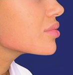 Remplissage des lèvres, du menton et de la mâchoire avant et après avec de l'acide hyaluronique pour un volume et une symétrie accrus