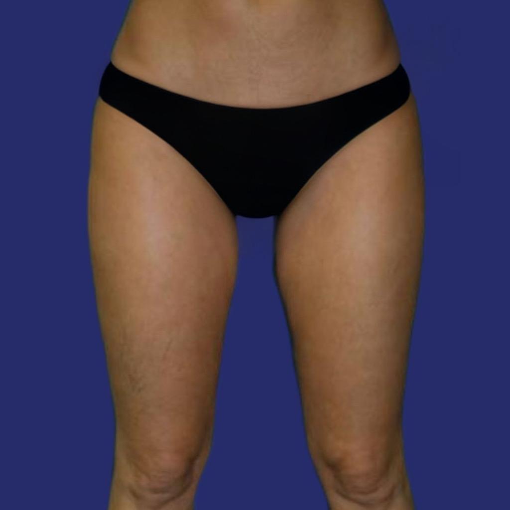 eliminate saddlebags and inner thighs - results