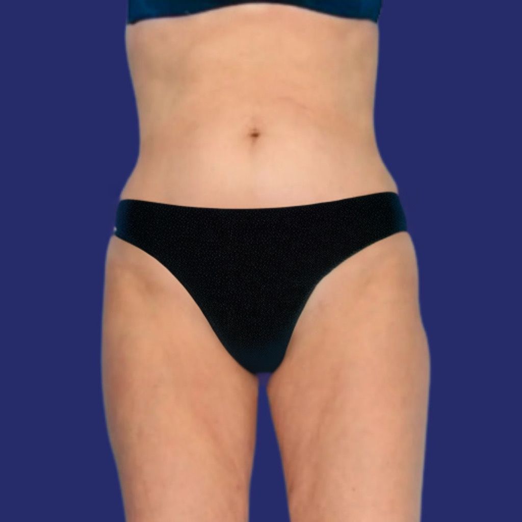 eliminate saddlebags liposuction results