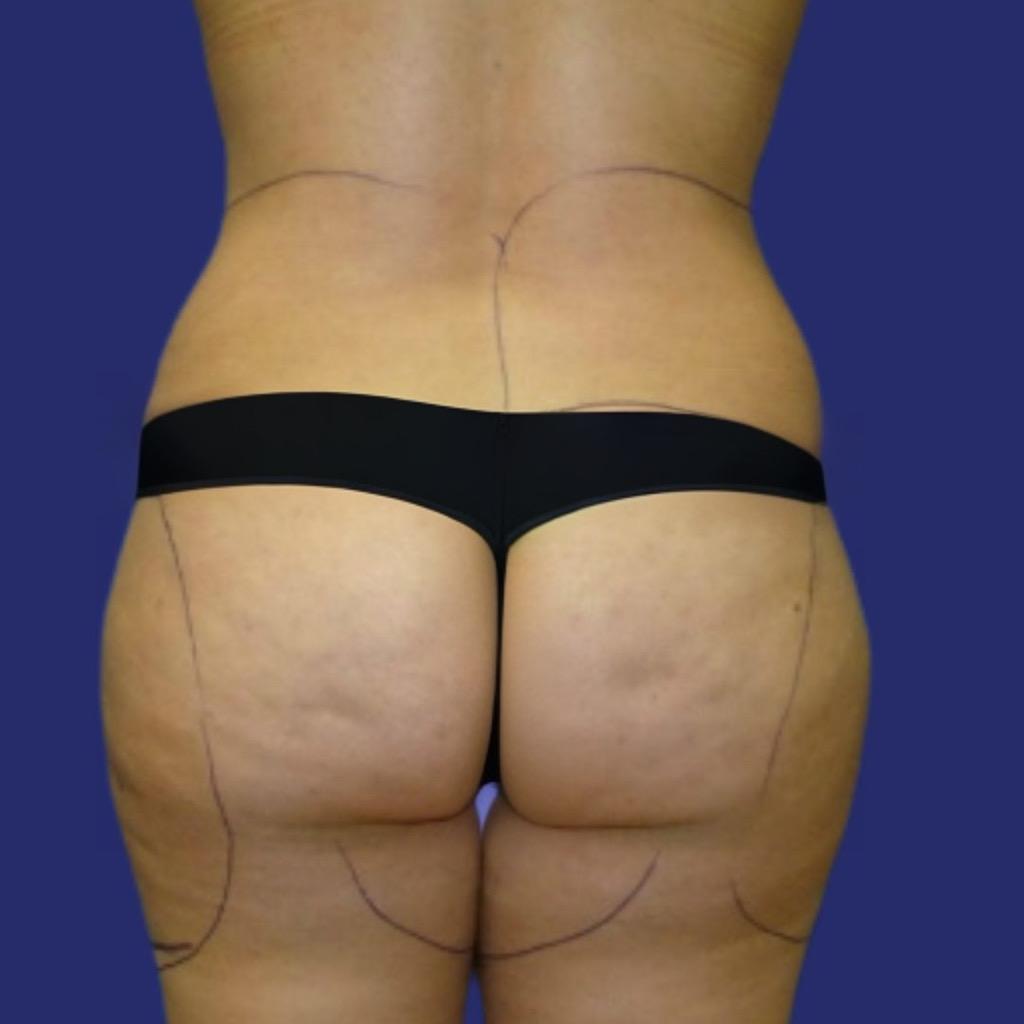 liposuction legs and buttocks