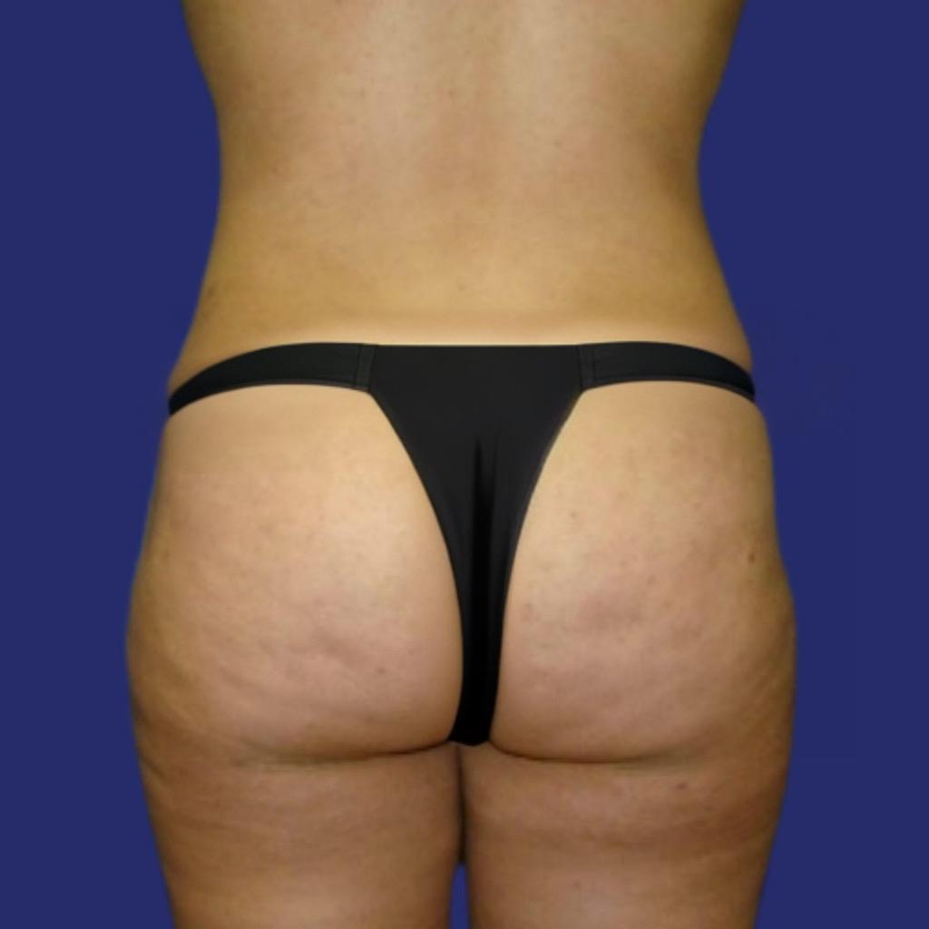 liposuction legs and buttocks results
