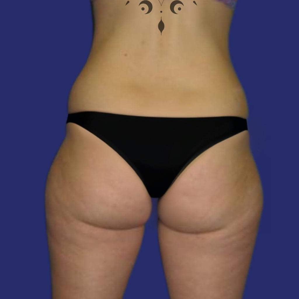Photo before liposuction thighs saddlebags