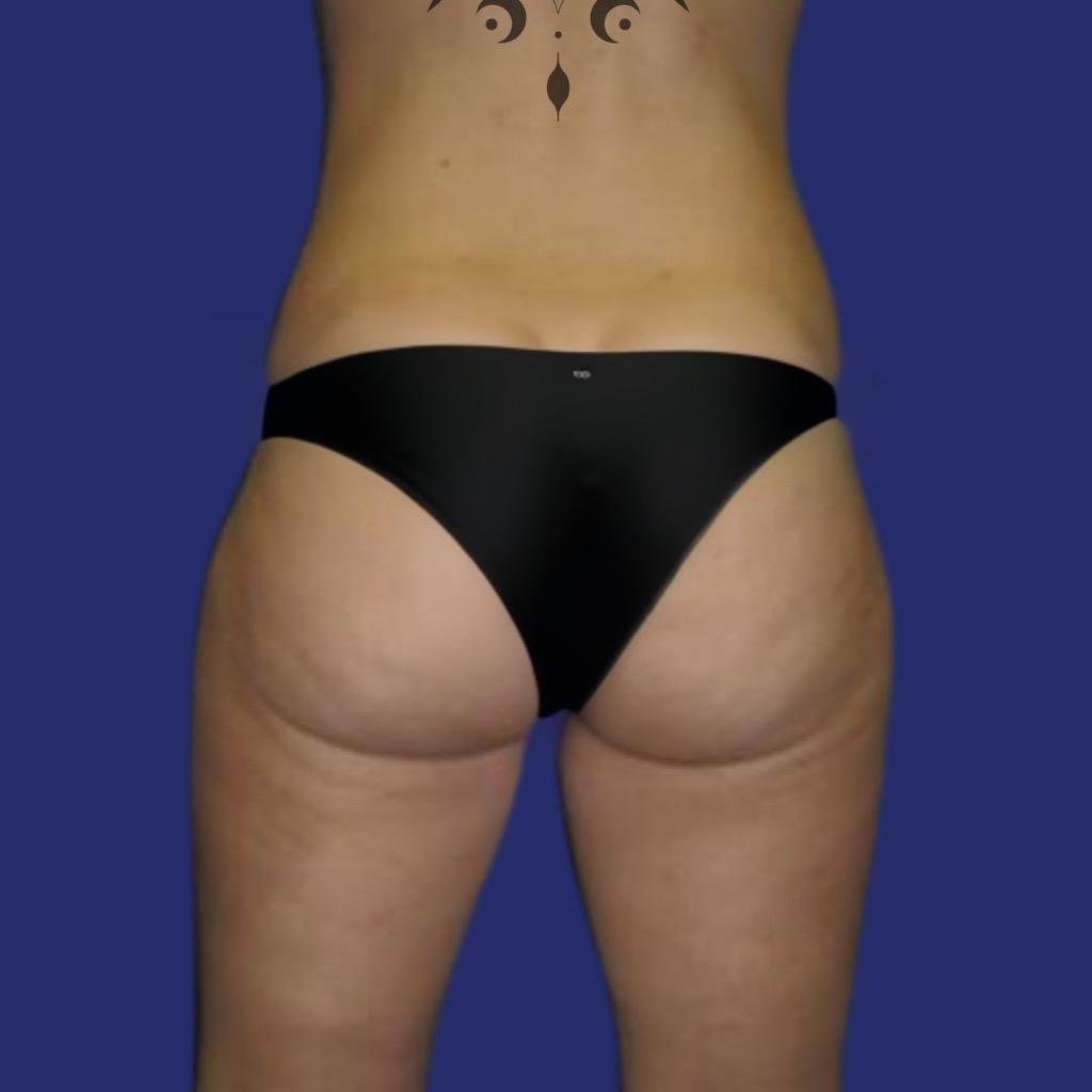 Photo after liposuction thighs saddlebags