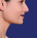 Foto der Ergebnisse der Fettabsaugung des Doppelkinns