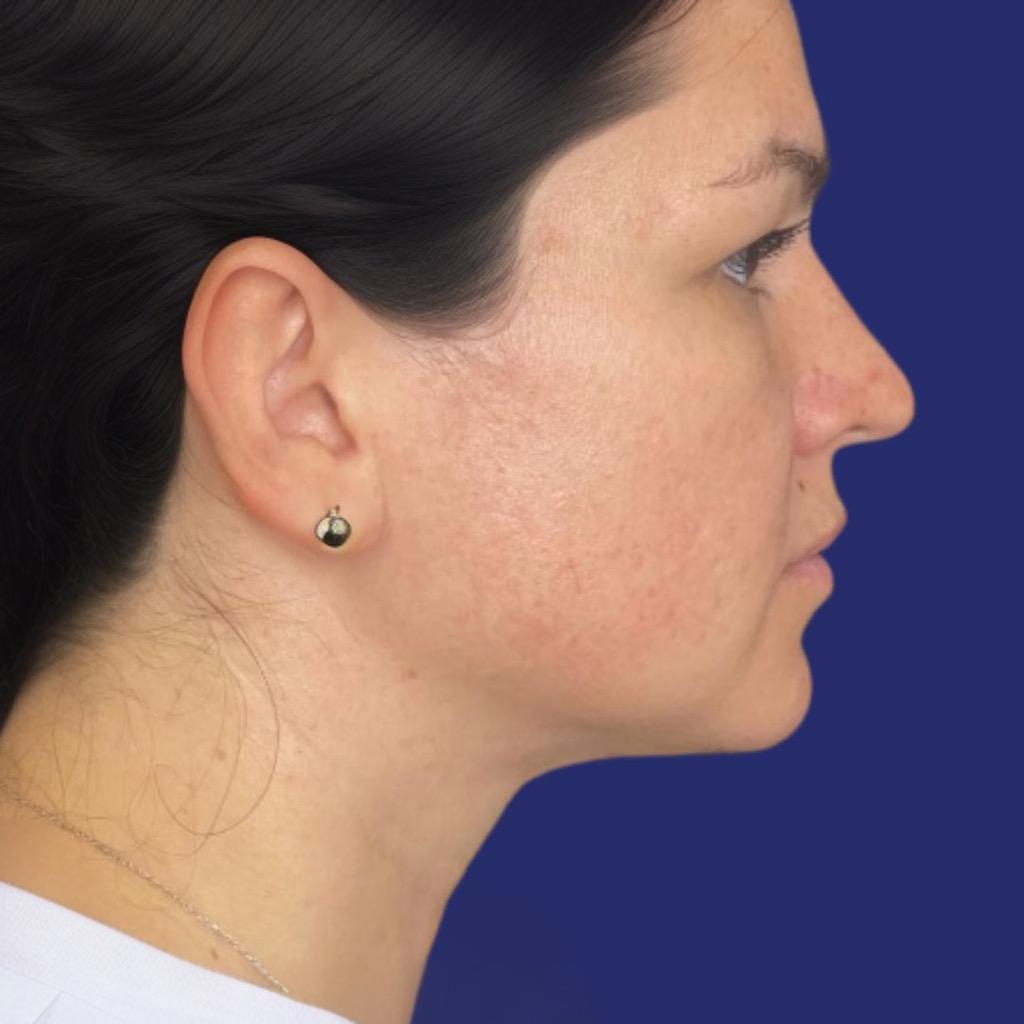 Natuurlijke resultaten van de lipo voor de dubbele kin