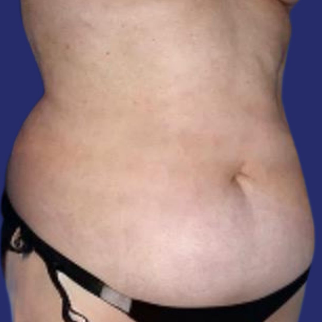 Tummy correction before and after photos