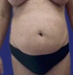 Liposuctie + abdominoplastie