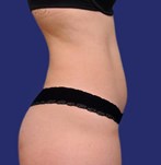 Liposuctie buik