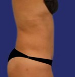 Foto van de resultaten van een echte patiënt na liposuctie