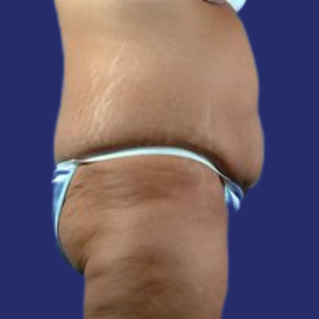 Side view of flabby abdomen before Fleur-de-Lis Tummy Tuck