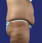 Seitenansicht eines schlaffen Bauches vor einer Fleur-de-Lis-Bauchdeckenstraffung