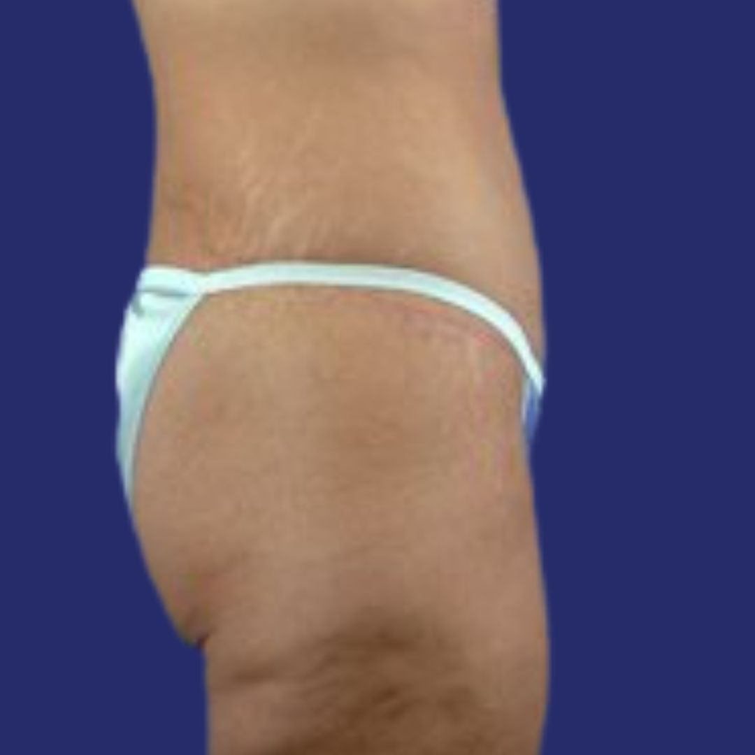Side view of defined abdomen after Fleur-de-Lis Tummy Tuck