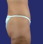 Seitenansicht eines definierten Bauches nach einer Fleur-de-Lis-Bauchdeckenstraffung