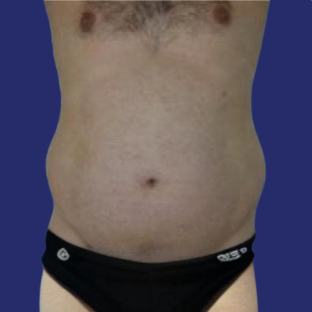 Patient with prominent abdomen before abdominoplasty surgery 
