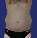 Patient mit prominentem Bauch vor einer Abdominoplastik kombiniert mit Fettabsaugung Patient mit festem und flachem Bauch nach der Abdominoplastik
