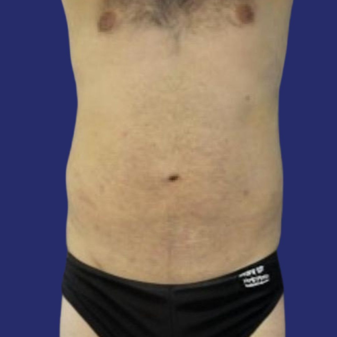 Patient with flat and toned abdomen after abdominoplasty surgery
