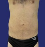 Patient mit festem und flachem Bauch nach der Abdominoplastik