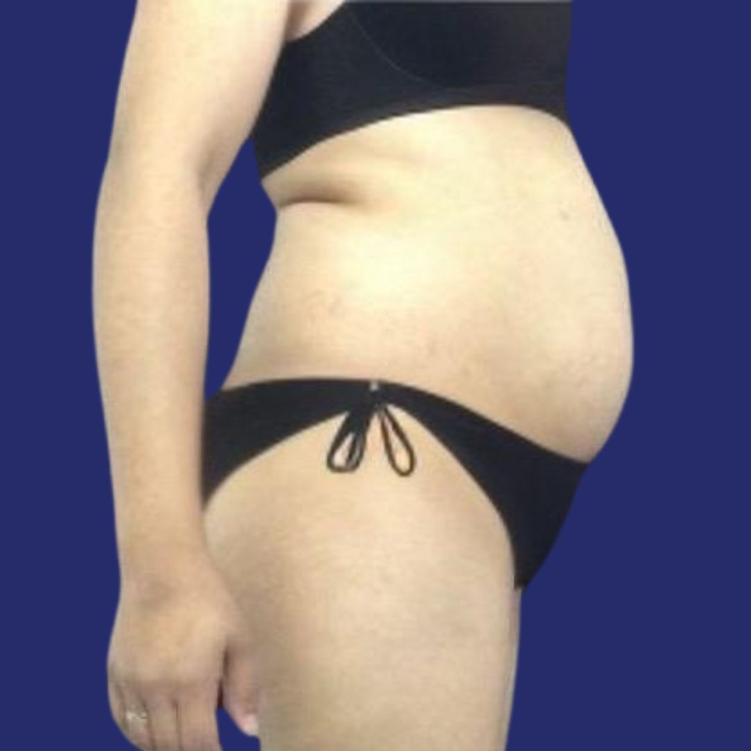 Abdomen before abdominoplasty surgery      