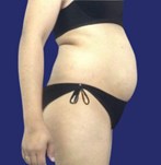 Patient mit prominentem Bauch vor einer Abdominoplastik kombiniert mit Fettabsaugung Patient mit festem und flachem Bauch nach der Abdominoplastik